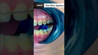 Check it Out - Twin Block Appliance | Orthodontic Twin Block Appliance ☑💉 #shorts #dentist #viral 🔥🔥