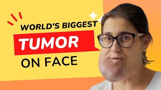 World's Biggest Facial Tumor [Amazing Story!]