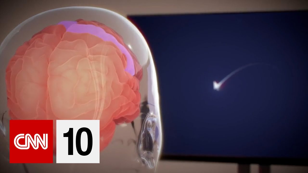 Read more about the article Elon Musk’s Neuralink implants chip in its first human brain | February 1 2024 – CNN 10