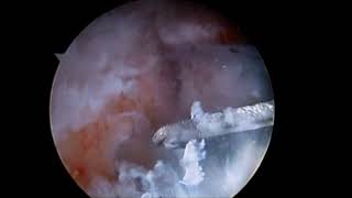 Arthroscopic Distal Clavicular Autograft for Treating Shoulder Instability With Glenoid Bone Loss 2