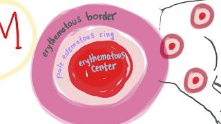 Erythema Multiforme With Mnemonic - All You Need To Know