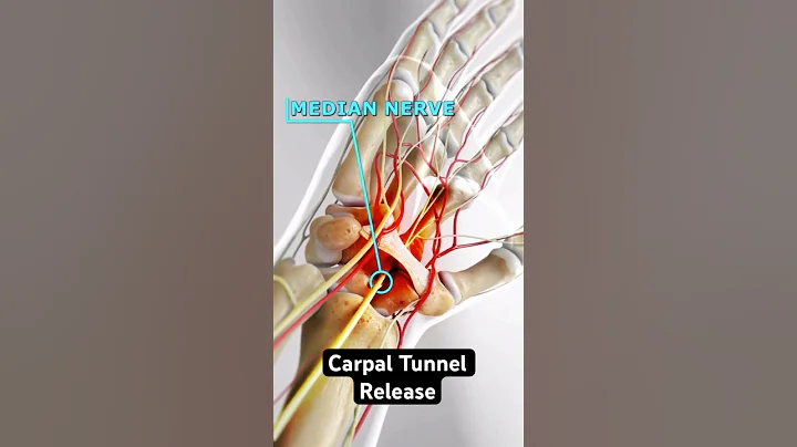 Relieving the pain of carpal tunnel syndrome (3D Animation)