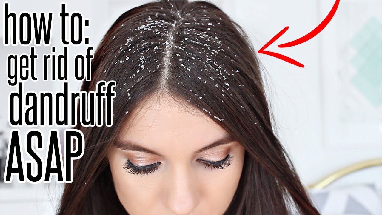 How To Get Rid Of Dandruff After ONE WASH !! - thptnganamst.edu.vn