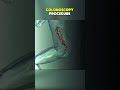 Colonoscopy Procedure|3D ANIMATIONS| #Colonoscopy#ColonoscopyProcedure#ColonoscopyPrep#fyp