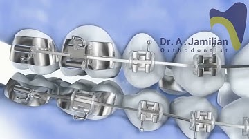 How Fixed Functional Appliances Work In Orthodontics!