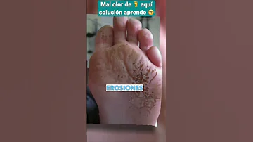 ¿Cómo quitar la bacteria de los pies?