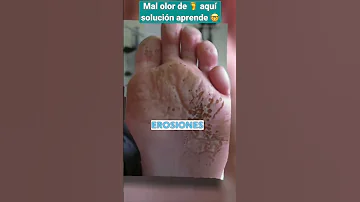 ¿Cómo eliminar las bacterias en los pies?