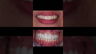 Congenitally Missing Lateral Incisors Fixed | Ortho + Restorative Solution