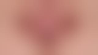 COMBINED LABIAPLASTY for sex rejuvenation