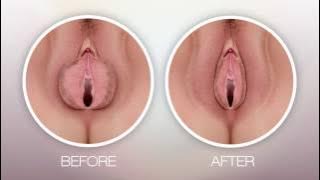 COMBINED LABIAPLASTY for sex rejuvenation