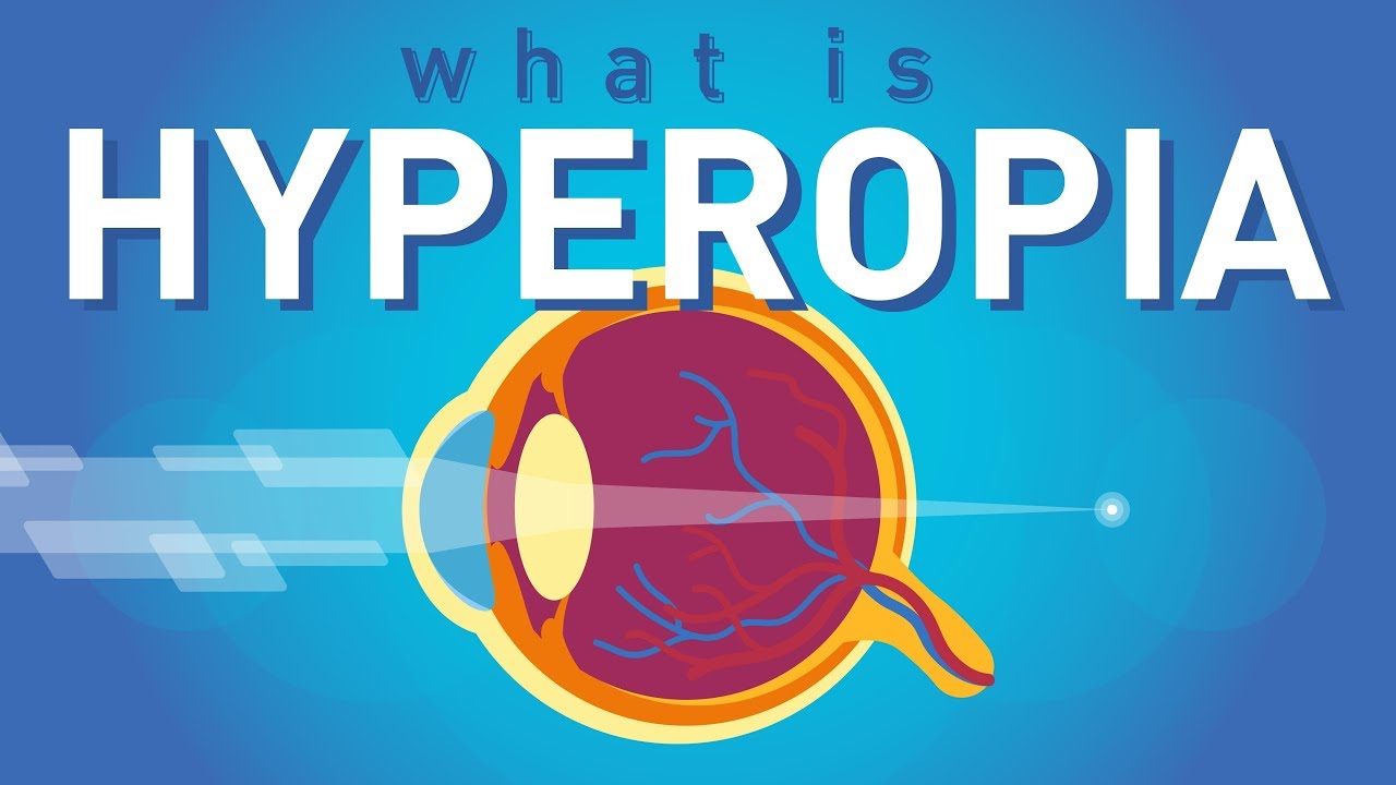 a hyperopia oka