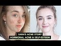 🌴How I Cleared Up My Skin : Sara's Acne Story • Confidence & Self-esteem with Acne