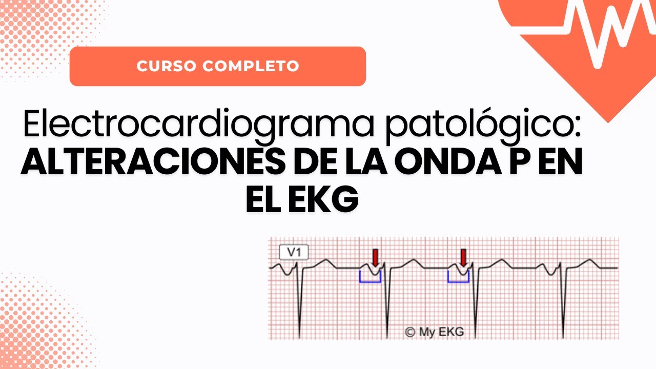 Alteraciones de la Onda P en el EKG: HIPERTROFIA AURICULAR DERECHA E IZQUIERDA