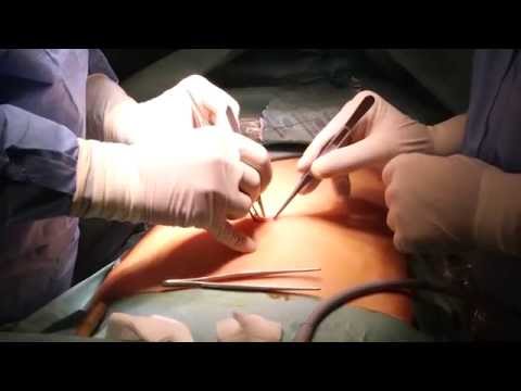 chirurgie reconstructivă a articulației șoldului după bolile purulente)