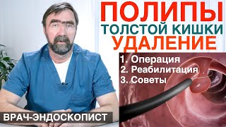 ПОЛИПЫ ТОЛСТОЙ КИШКИ - удаление полипов кишечника, ОПЕРАЦИЯ, осложнения,рекомендации после удаления