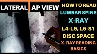 Lower Back X RAY How to Read, L4 L5 S1 Lumbosacral X Ray Reading, Lumbar Spine X RAY Complete Study screenshot 4