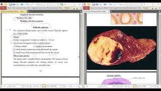 MU3 Endocrine Patho Thyroid tumors  parathyroid