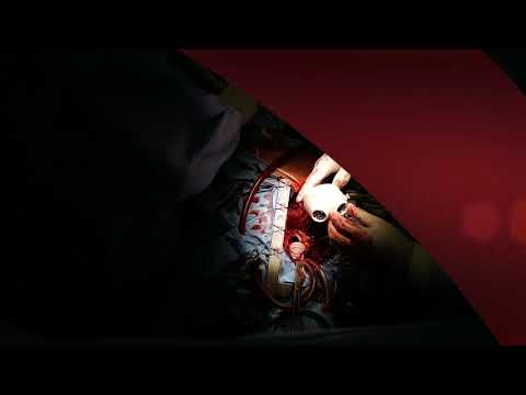 Implantácia umelého srdca SynCardia TAH