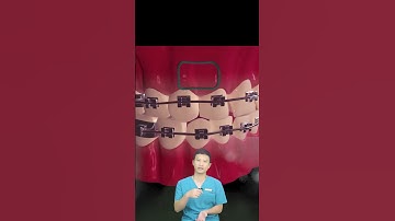 Đóng Khít Khe Thưa Của Răng Bằng Niềng Răng! | Nha Khoa Minh Châu