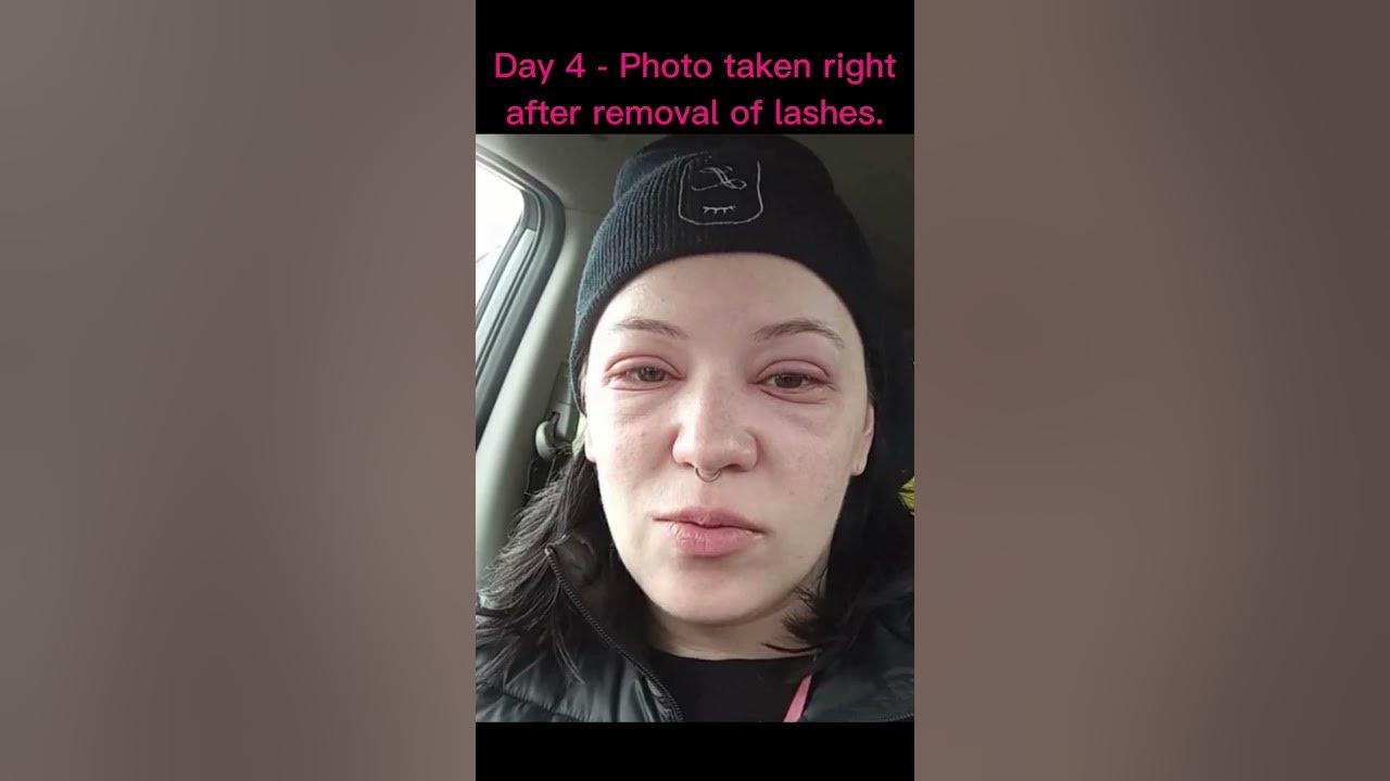 shorts What Does an Allergic Reaction to Cyanoacrylate Look Like? YouTube