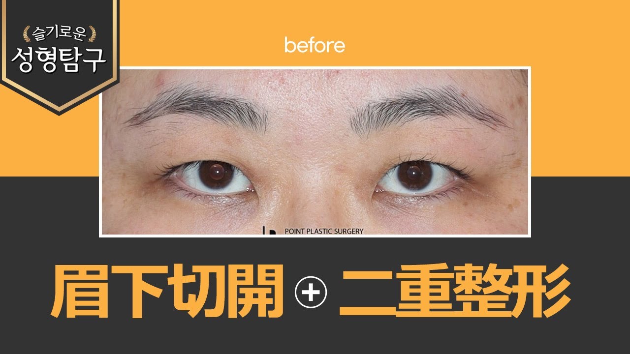 【韓国二重整形】眉下切開と二重整形でキツイ印象から優しい印象へ！