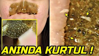 Si̇yah Nokta Temi̇zleme Maskesi̇ Kökünden Sök Aninda Kurtul Güzellik Bakım