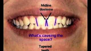 Dr  Morgan Vit l escence Demonstration Part 1