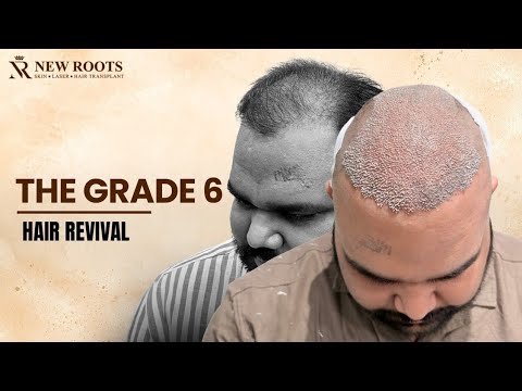 6200 Grafts in One Surgery! 😳 | Grade 6 Baldness | Hair Transplant Cost and Results in Lucknow