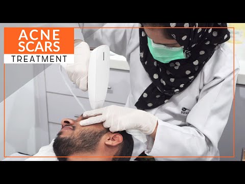 No More Acne Scars | ACNE SCARS TREATMENT | FDA Approved | No Side Effects