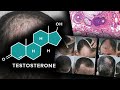 Scalp Hair Shouldn't Need Testosterone to Grow because...