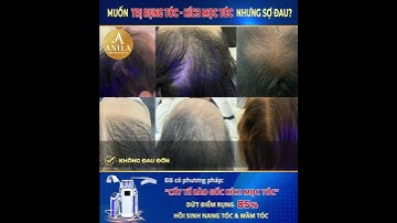 Cấy tế bào gốc kích mọc tóc có đau không?