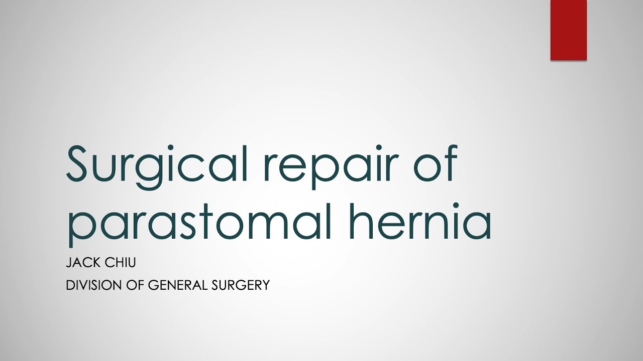 Surgical Repair of Parastomal Hernia by Jack Chiu, Division of General