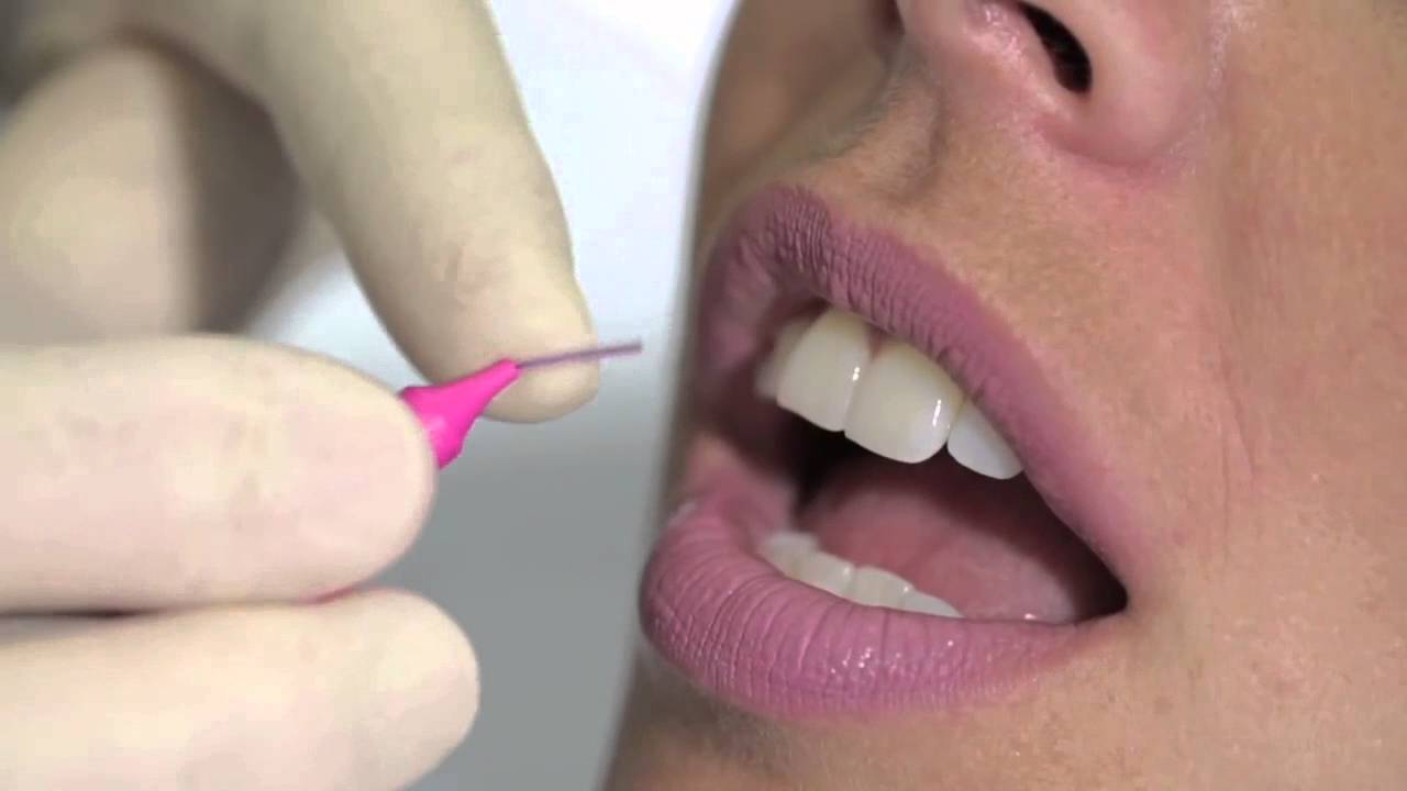 Come si usa lo scovolino per denti in modo corretto