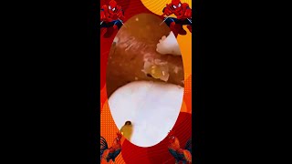 Blackheads Removal | Acne Treatment and Very Satisfying Satisfying Pimple pop #blackheads