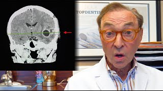 CRAZY Story! 🧠  Brain Abscess From an Infected Tooth 🦷