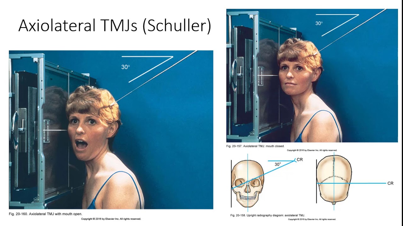 Tmj Chart