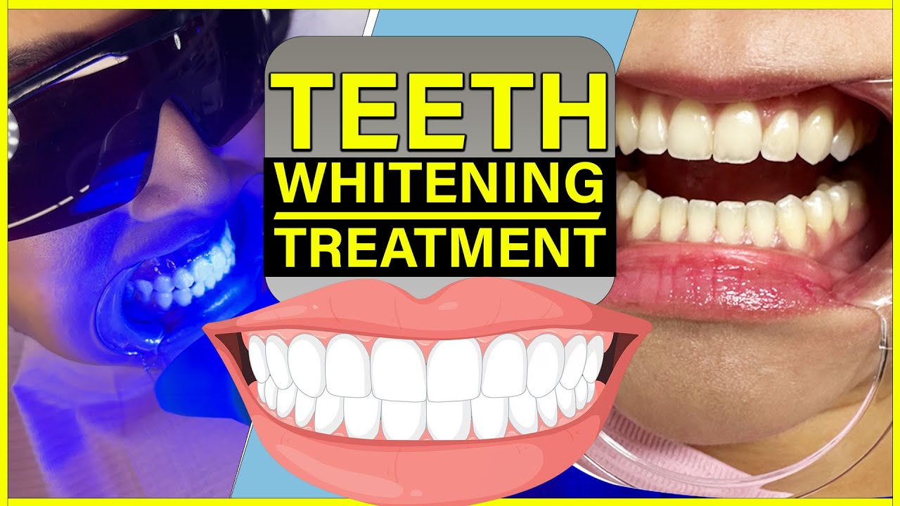 Teeth Whitening Hacks | Smile Designing And Teeth Whitening Treatment | Beloria Academy