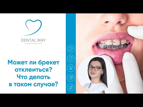 Может ли брекет отклеиться? Что делать в таком случае? #Shorts