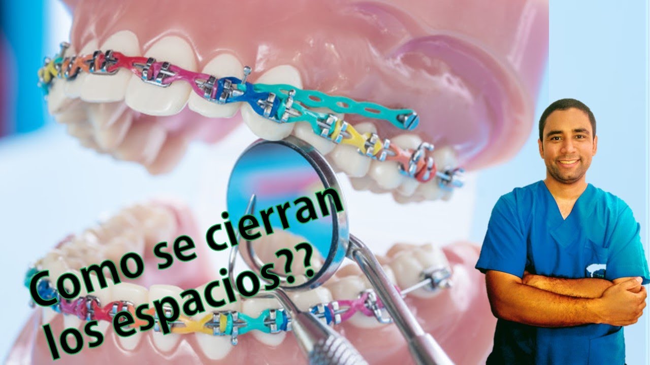 Como se Cierran los Espacios en Ortodoncia con Elásticos continuos?😎
