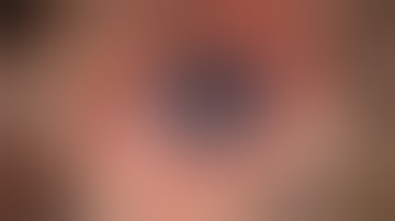 Amniotic membrane transplantation for persistent epithelial defect