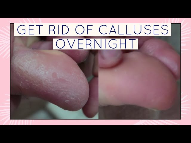 How to Get Rid of Calluses: 6 At-Home Tips Dermstore