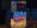 حل مشكلة تداخل الاسنان في برنامج ال 
