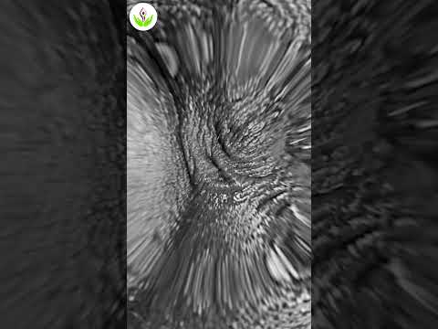 MTF Male To Female Sex Reassignment Vagina Creation Surgery With Sigmoid Colon Vagina Dilation