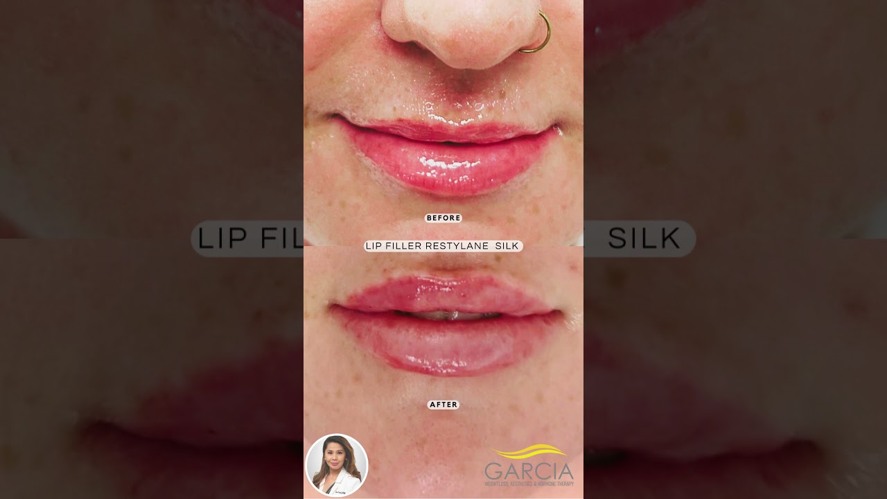 Can you say another satisfied customer!!!  Restylane Silk Lip Filler by Imee, APRN, FNP-C Brandon.