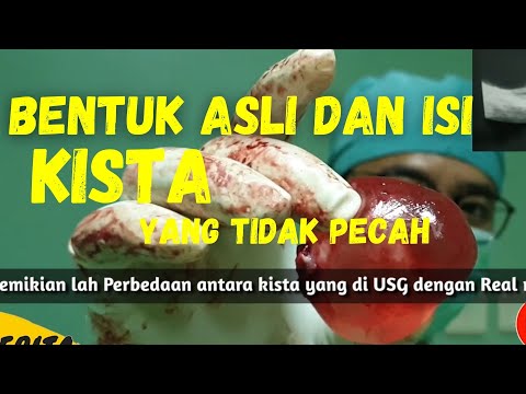 Video: Pengangkatan Kista Sinus Maksilaris: Jenis Operasi Dan Fiturnya