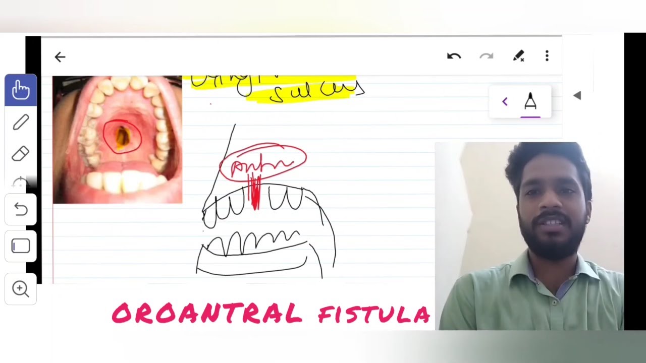 ОРОАНТРАЛЬНЫЙ СВИЩ