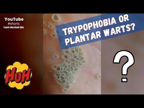 Trypophobia or plantar warts? #shorts