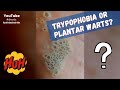 Trypophobia or plantar warts shorts