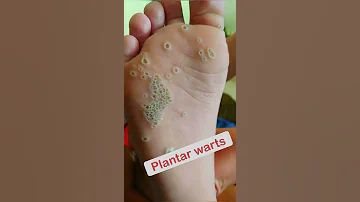 Trypophobia Or Plantar Warts Shorts 