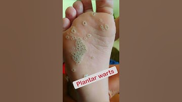 Thumbnail of Trypophobia or plantar warts? #shorts